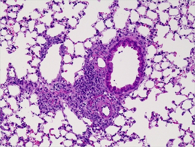 Image: Lung with asthma symptoms...